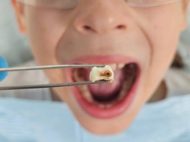 Best Emergency Treatment for Dental Infections or Abscesses in Trooper, PA